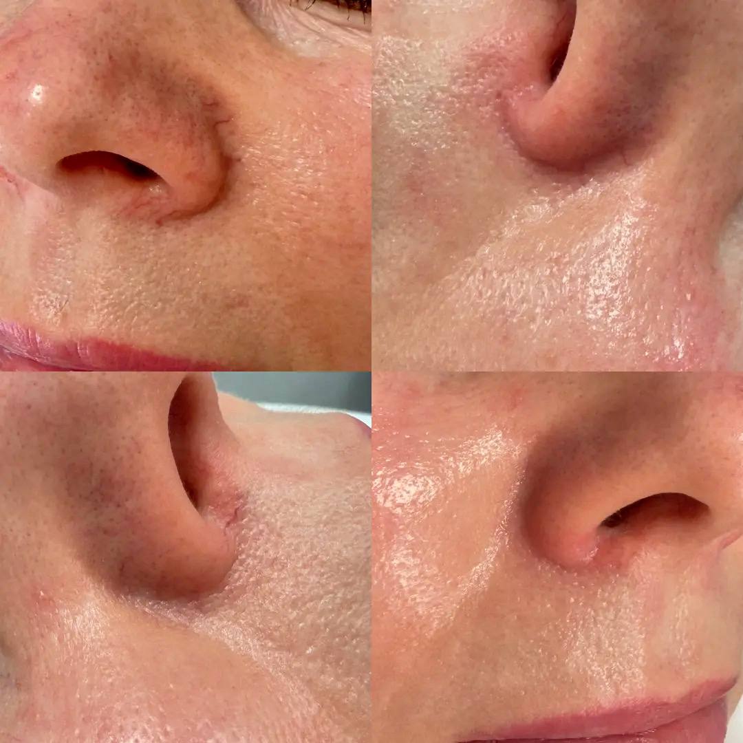 Фотоомоложение Lumecca